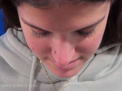 Rhinoplasty Before & After Patient #1454