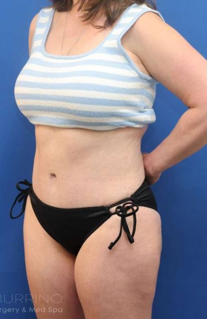 Liposuction Before & After Patient #641