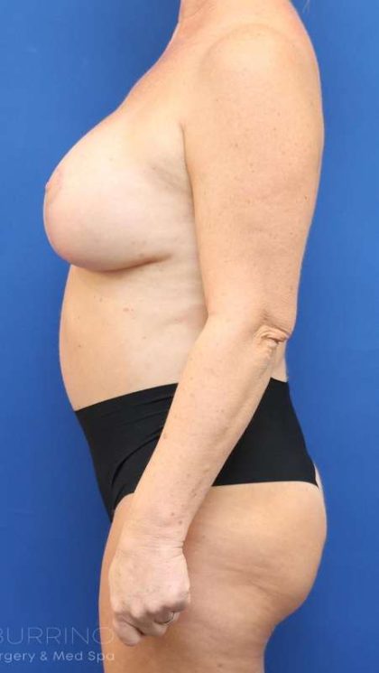 Liposuction Before & After Patient #626