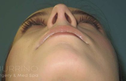 Rhinoplasty Before & After Patient #1439