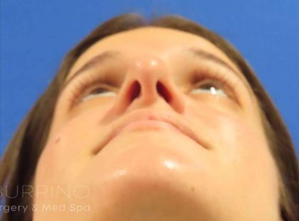 Rhinoplasty Before & After Patient #1454