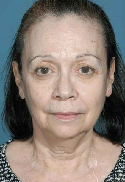 Chemical Peel Before & After Patient #429