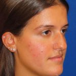 Rhinoplasty Before & After Patient #1454