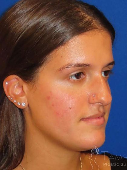 Rhinoplasty Before & After Patient #1454