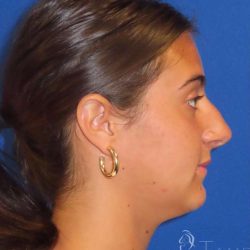 Rhinoplasty Before & After Patient #1465