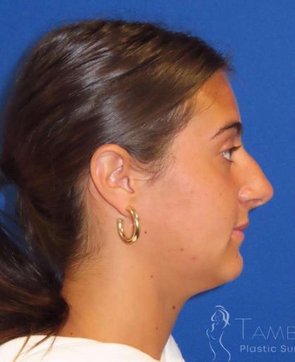 Rhinoplasty Before & After Patient #1465