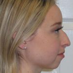 Rhinoplasty Before & After Patient #1476