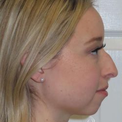 Rhinoplasty Before & After Patient #1476
