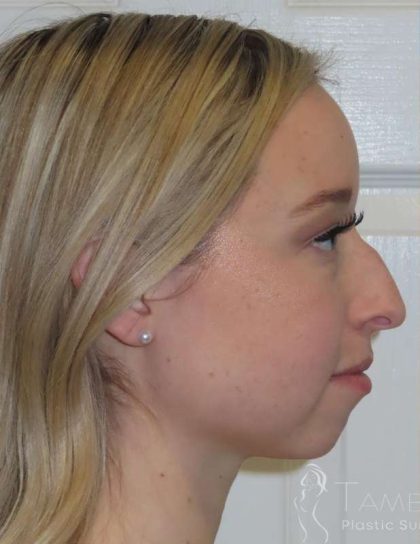 Rhinoplasty Before & After Patient #1476
