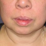 Neck Lift Before & After Patient #1498