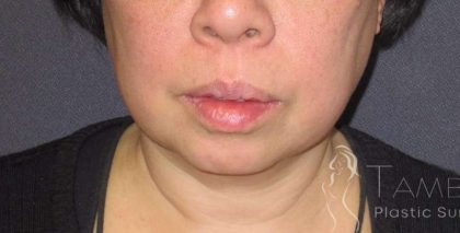 Neck Lift Before & After Patient #1498