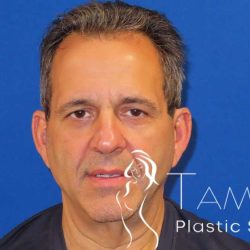 Neck Lift Before & After Patient #1560