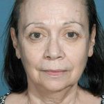 Neck Lift Before & After Patient #1567
