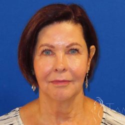 Neck Lift Before & After Patient #1578