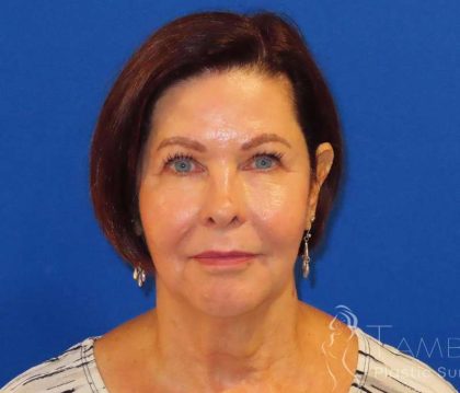 Neck Lift Before & After Patient #1578