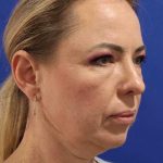 Facelift Before & After Patient #1609
