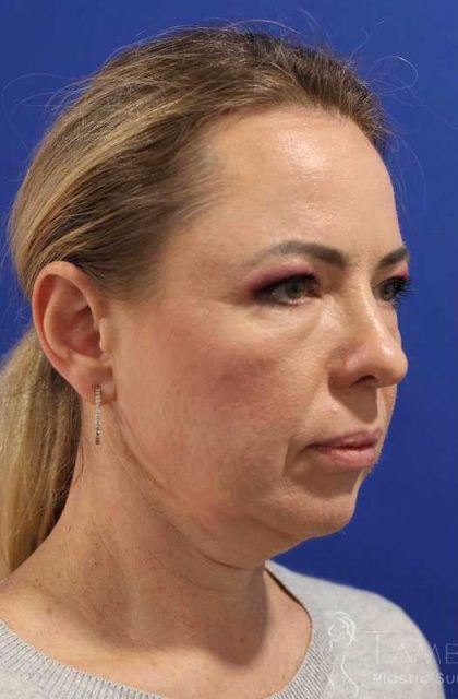 Facelift Before & After Patient #1609