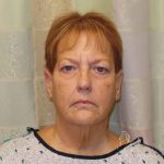 Facelift Before & After Patient #1620