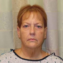 Facelift Before & After Patient #1620