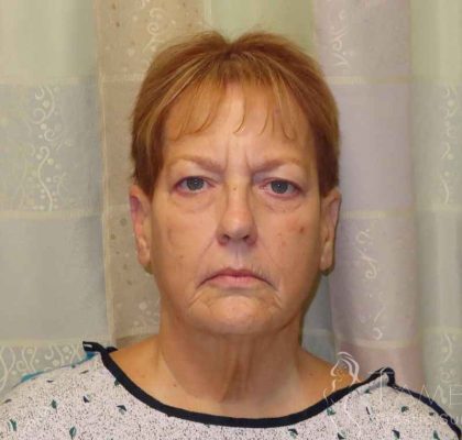 Facelift Before & After Patient #1620
