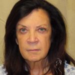 Facelift Before & After Patient #1631