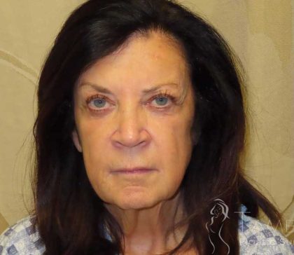 Facelift Before & After Patient #1631
