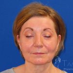 Facelift Before & After Patient #1642