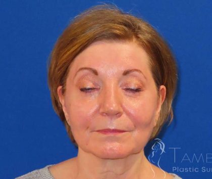 Facelift Before & After Patient #1642