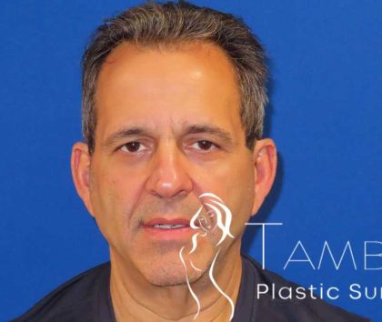 Facelift Before & After Patient #1653