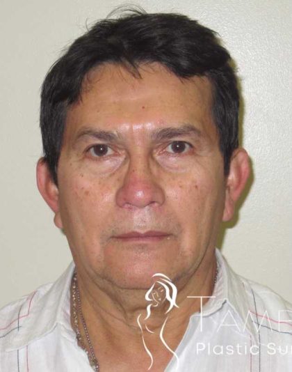 Facelift Before & After Patient #1664