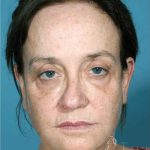 Facelift Before & After Patient #1682