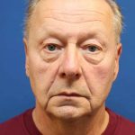 Facelift Before & After Patient #1693