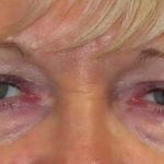 Eyelid Lift Before & After Patient #1703