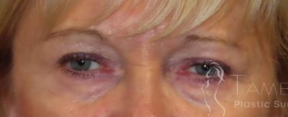 Eyelid Lift Before & After Patient #1703