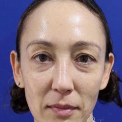 Eyelid Lift Before & After Patient #1708
