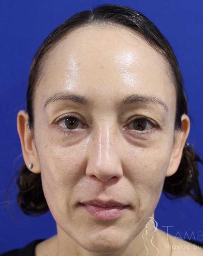 Eyelid Lift Before & After Patient #1708