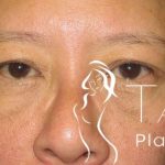 Eyelid Lift Before & After Patient #1711