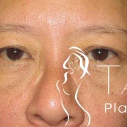 Eyelid Lift Before & After Patient #1711