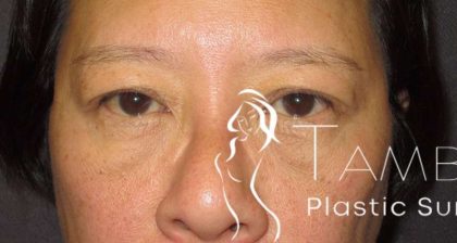 Eyelid Lift Before & After Patient #1711