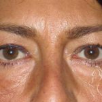 Eyelid Lift Before & After Patient #1714