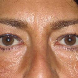 Eyelid Lift Before & After Patient #1714