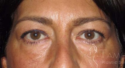 Eyelid Lift Before & After Patient #1714