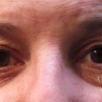 Eyelid Lift Before & After Patient #1717