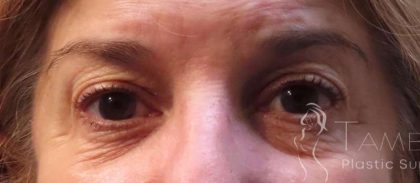 Eyelid Lift Before & After Patient #1717