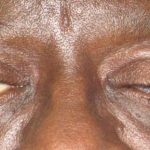 Eyelid Lift Before & After Patient #1720