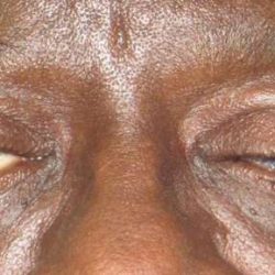 Eyelid Lift Before & After Patient #1720