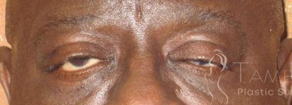Eyelid Lift Before & After Patient #1720