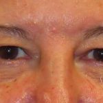 Eyelid Lift Before & After Patient #1723