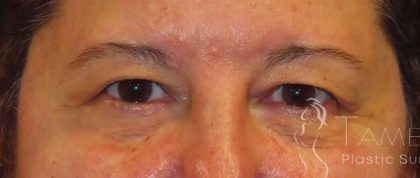 Eyelid Lift Before & After Patient #1723