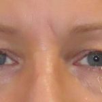 Eyelid Lift Before & After Patient #1726